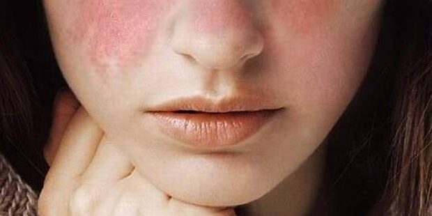 Lupus-image-620×388